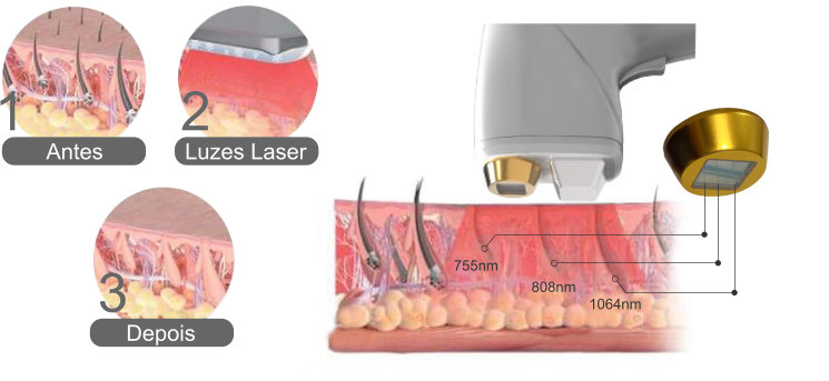 Cabeçalho de LASER de pêlo de 3 bandas e os seus resultados na epiderme e derme